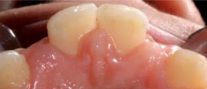 Figure 25 : Vue palatine du secteur antérieur, on note une position très coronaire de la gencive palatine  (Dr Beaugrand)