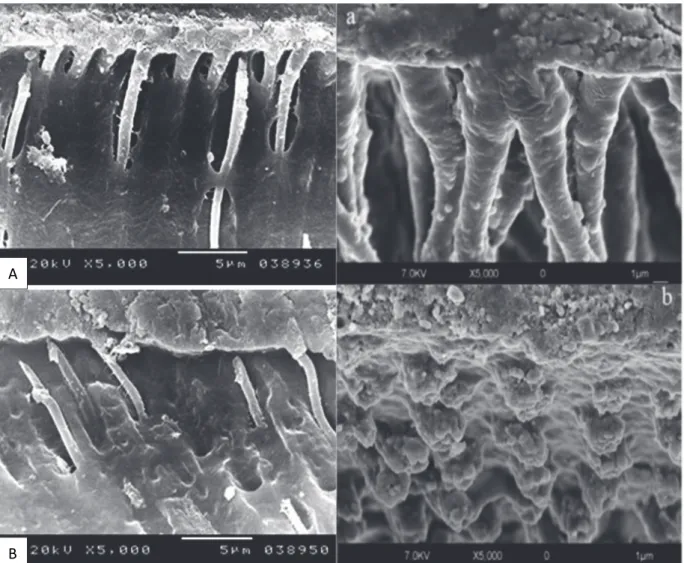 Figure 1 : Observation au Microscope électronique à Balayage de la couche hybride et des macro-brides dans la dentine du Scotchbond Universal en utilisation (A) : MR, et en utilisation (B) : SAM  (18)  