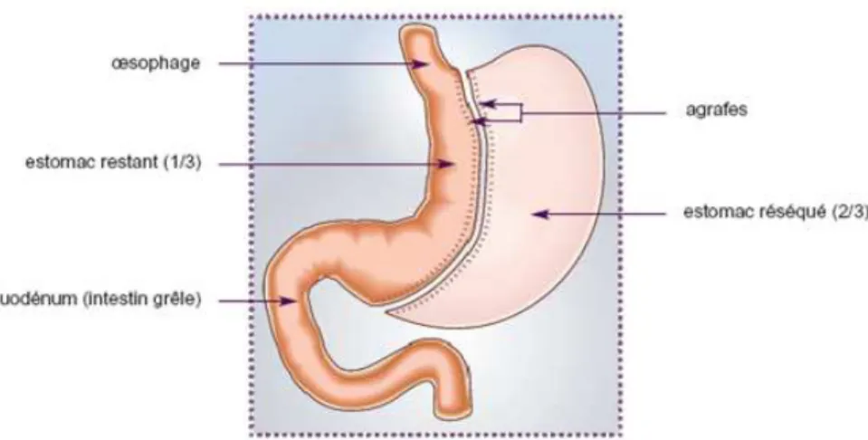 Figure 6 : Schéma du by-pass gastrique en Y 