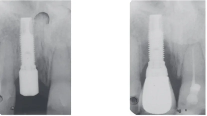Fig. 20 : Diagnostic radiographique d’une lésion péri‐implantaire à 8 ans (Dr GLISE JM) 