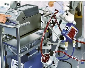 Figure 1. Circuit d’ECMO. 1 : la pompe, 2 : l’oxygénateur, 3 : la console du circuit  On distingue deux entités : les ECMO périphériques et les ECMO centrales