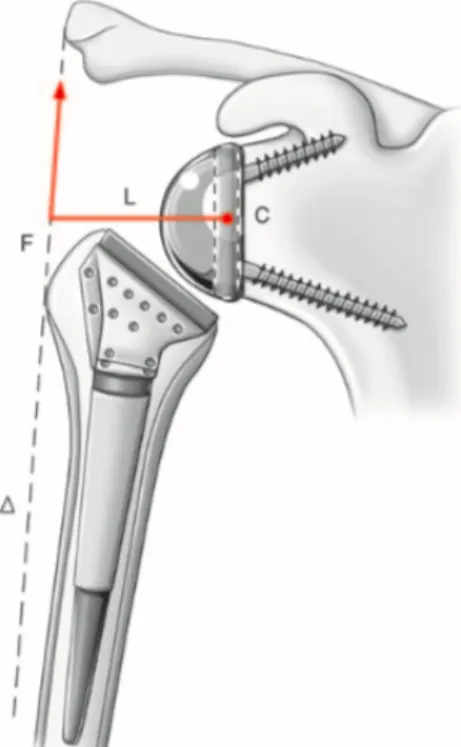 Figure 1. Concept de prothèse inversée de Grammont 