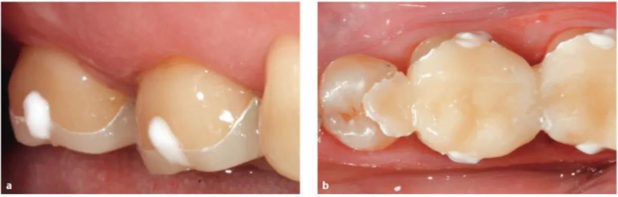 Figure 13 - Temporisation avec extensions vestibulaires et linguales de composite  63 Enfin  si  un  système  de  CFAO  est  mis  en  œuvre  :  le  risque  de  contamination  et  de  détérioration de la dent est évité 