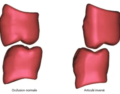 Figure 12 : Différence entre occlusion normale et articulé inversé (98) 