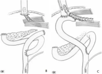 Figure 4 : Intubation d'une anastomose œso-jéjunale ou d'un moignon œsophagien par  un drain Hélisonde® (d’après l’EMC) 