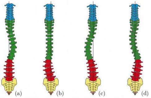 Figure 19 Différents types de courbures scoliotiques : scoliose thoracique (a), thoraco-lombaire (c) lombaire (b) ou  double majeur (d) et la scoliose double thoracique   