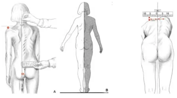 Figure 21 Examen de l'équilibre frontal et mesure de la gibbosité