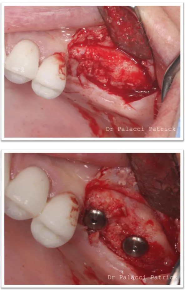 Figure 9 : Cicatrisation à 4 mois post-opératoire avec pose d’implants en position de 26 et 27 