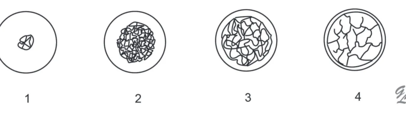 Figure 1 : Schématisation des quatre types osseux selon Lekholm et Zarb. (6)