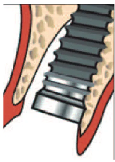 Figure 8 : Schéma de la position sagittale de l’implant dans l’alvéole