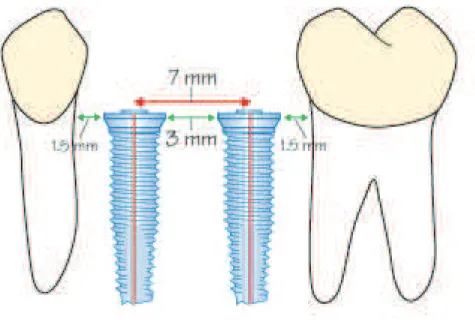 Figure 9 : Schéma des distances de sécurité inter-implants et entre une dent et un  implant