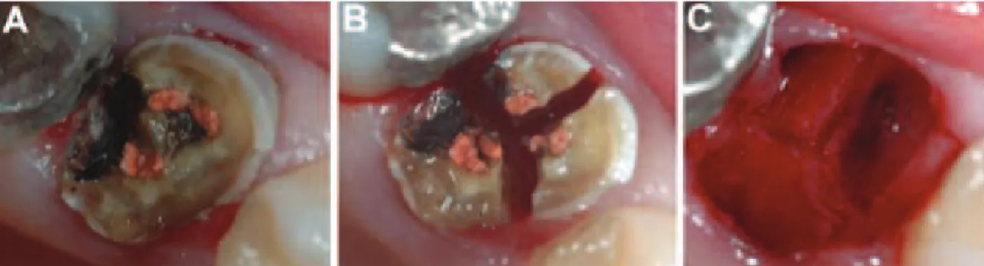 Figure 11 : séparation radiculaire d’une première molaire maxillaire  (42)