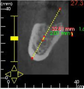 Figure 9 : 2 mm de sécurité par rapport au canal mandibulaire