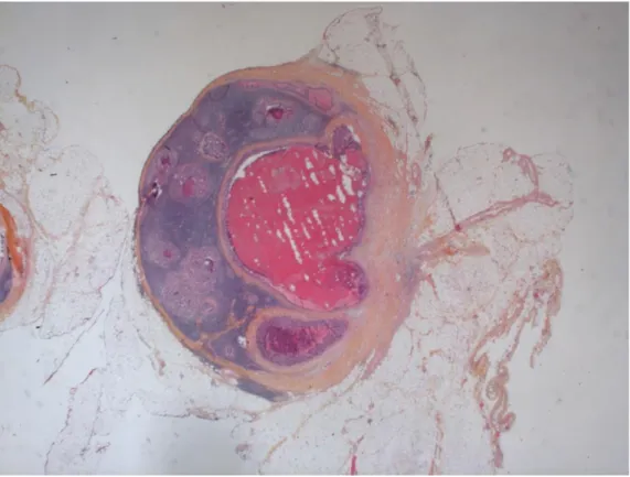 Figure n°17 : Métastase ganglionnaire d’un ADK sans rupture capsulaire (HES, x20).