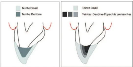 Figure 1 : Différentes techniques de stratifications : technique en 2 couches (1), technique  en 3 couches (2), technique de Dietschi (3) et technique de Vanini (4) (20)  