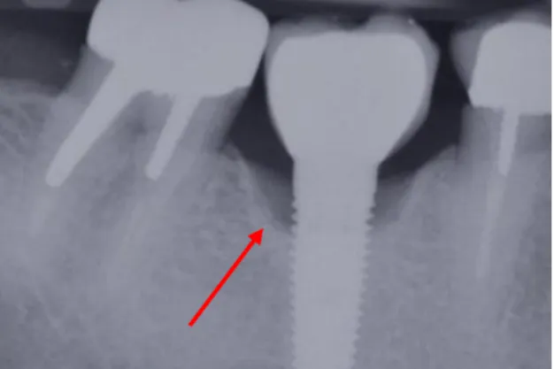 Figure 2 : Image radiologique typique d’une péri-implantite 