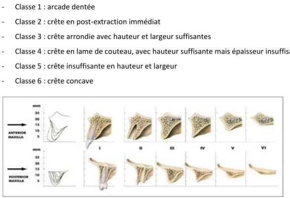 Figure 9 : Evolution du volume osseux résiduel au maxillaire suite à une avulsion, de Cawood et Howell  Cet amincissement à l’origine de la finesse des parois osseuses est fortement préjudiciable  lors d’une explantation,  puisqu’il augmente le rapprocheme