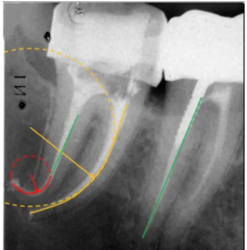 Figure 24 : Différence de rayon de courbure  canalaire entre une 46 et une 47 