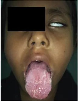Figure 9 : Paralysie faciale chez une jeune fille présentant un SMR (39). 