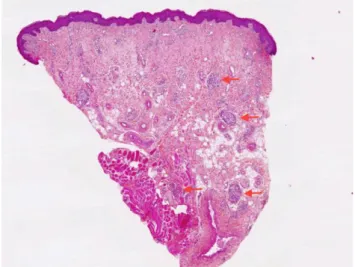 Figure 10 : Aspect histologique à faible grossissement. Les flèches rouges montrent les  granulomes inflammatoires au sein du chorion et du muscle en profondeur (31)