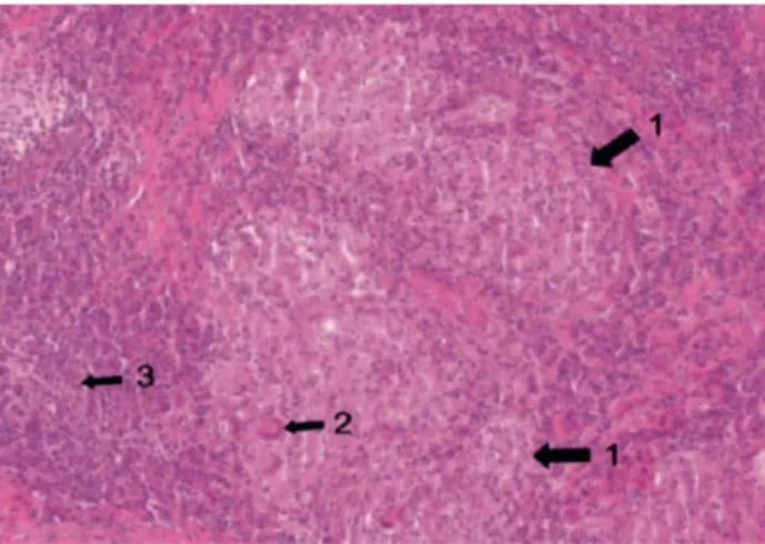 Figure  12 : Aspect histopatholologique de la lésion : au sein du chorion, présence de  granulomes épithélioïdes (flèche 1) et giganto-celullaires sans nécrose caséeuse centrale