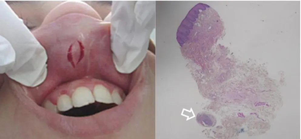 Figure 14 : Biopsie en profondeur de la lèvre supérieure Exemple de prélèvement pour lequel il  existe un granulome unique dans une position profonde(46)