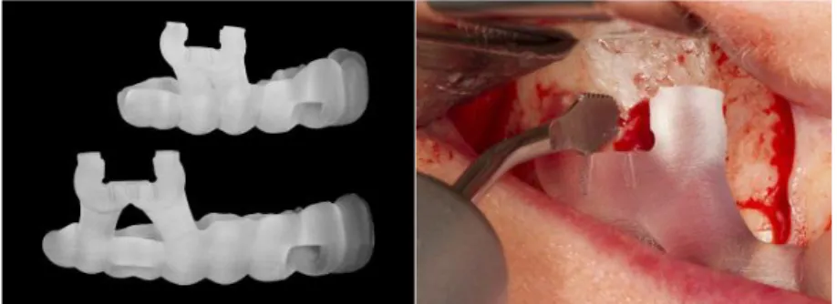 Figure 2 : à gauche : guide chirurgical imprimé, à droite :                                                                           guide chirurgical mis en bouche (Strbac et al