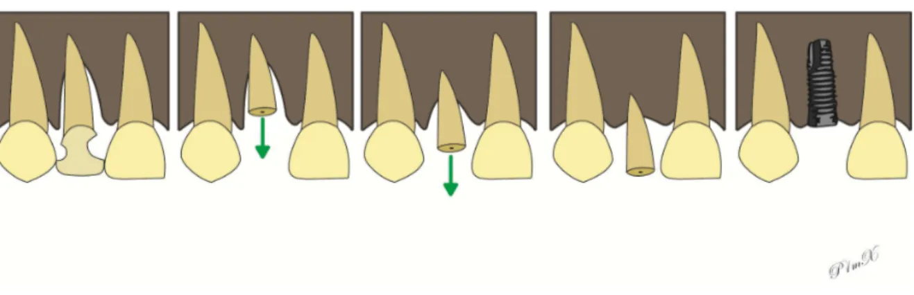 Figure 1 - Principe de l’extraction orthodontique