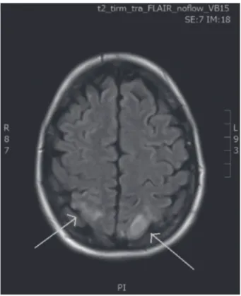 Fig. 1.  —    MRI performed during episode of blindness: 