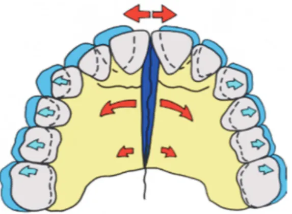 FIGURE 22 : Schéma illustrant l’action d’un disjoncteur pour une expansion transversale maxillaire (19) 