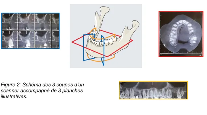 Figure 2 : Schéma des 3 coupes d’un  scanner accompagné de 3 planches  illustratives. 