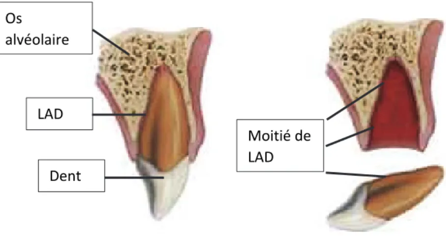 Figure 2 : Photographie intra-buccale d’une situation traumatique de luxation totale de l’incisive centrale 21 chez un patient  de 8 ans (13)