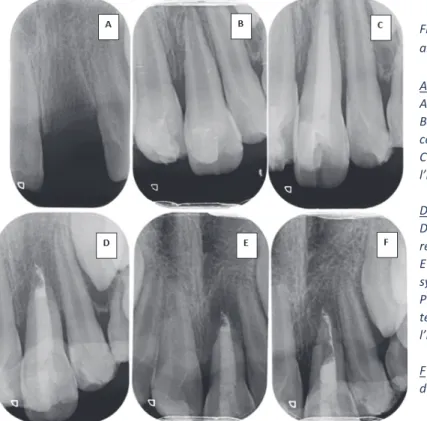 Figure 3 : Cas personnel d’un patient âgé de 8  ans avec une luxation totale de sa 21