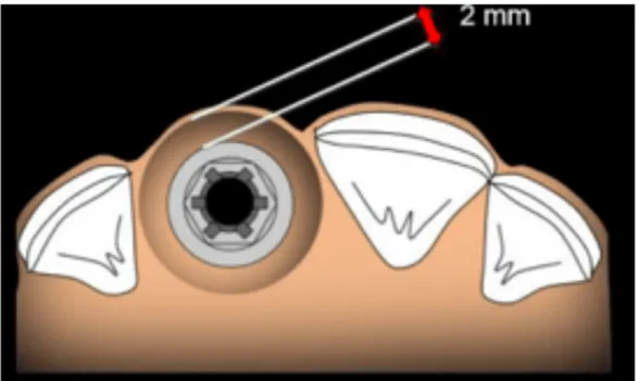 Figure 3 : distance minimum entre implant et dent et entre deux implants (13) 