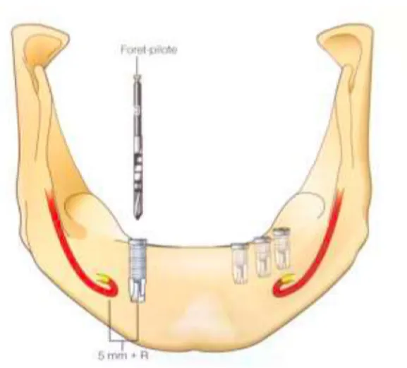 Figure 6 : distance de sécurité́ à respecter lors de l'implantation dans la région du foramen  mentonnier