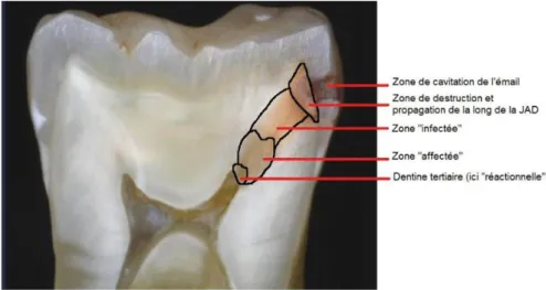 Fig. 2 : Zones de dentine cariée sur une coupe transversale de molaire[5]. 