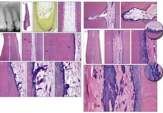 Fig.  3 :  Coupe  des  différentes  zones  de  l’organe  dentino-pulpaire  après  une  lésion  carieuse[6]