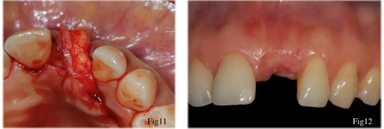 Figure 11 : rotation du conjonctif pédiculé du côté palatin vers le côté vestibulaire (source : Dr KELLER) 