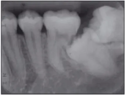 Figure 1 Radiographie péri-apicale montrant la résorption de la racine distale de la première  molaire mandibulaire due à l’inclusion (21) 