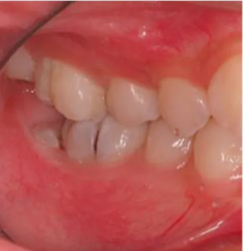 Figure 2 Seconde molaire mandibulaire enclavée (21) 