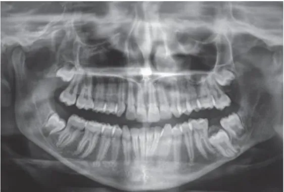 Figure 6 Radiographie panoramique montrant la deuxième molaire permanante incluse  piégeant le nerf alvéolaire inférieur (27) 