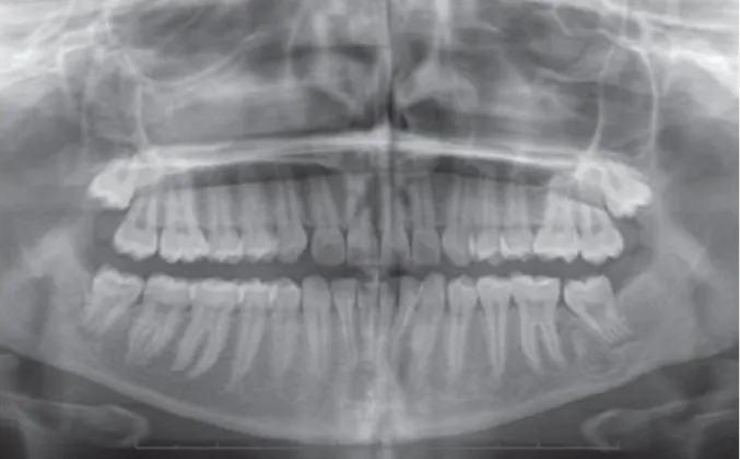 Figure 9 Formation osseuse post-opératoire sur le site chirurgical et migration mésiale de la  troisième molaire après 4 ans
