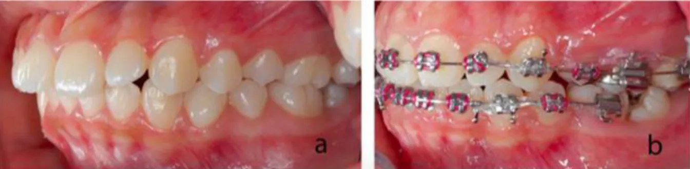 Figure 10 Désenclavement de la deuxième molaire mandibulaire après extraction de la  seconde prémolaire