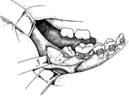 Figure 16 Mise en place d’un arc Niti dans le tube molaire collé après exposition chirurgicale d’une  seconde molaire mandibulaire mésioversée