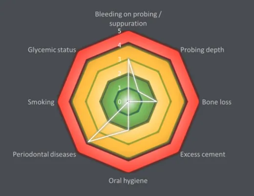 Figure  2:  Patient  with  low  peri-implantitis  risk:  3  out  of  6  implant  faces  with  bleeding  on  probing, a probing depth &lt; 4 mm on at least 2 faces of the implant, a bone resorption &lt; 30% of  the  implant  length  (screwed  prosthesis),  