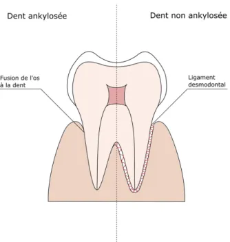 Figure 11. Ankylose dentaire. 