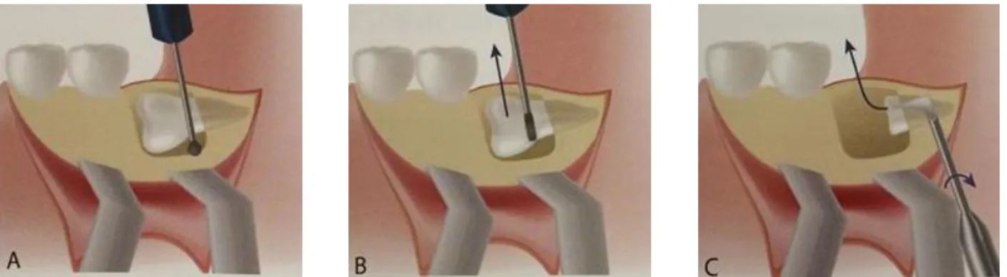 Figure 18. Etapes de l'avulsion d'une dent incluse en position horizontale. A : Exérèse osseuse libérant la couronne,   B : Section coronaire perpendiculaire au grand axe de la dent, C : Elimination de la racine distale puis des racines 