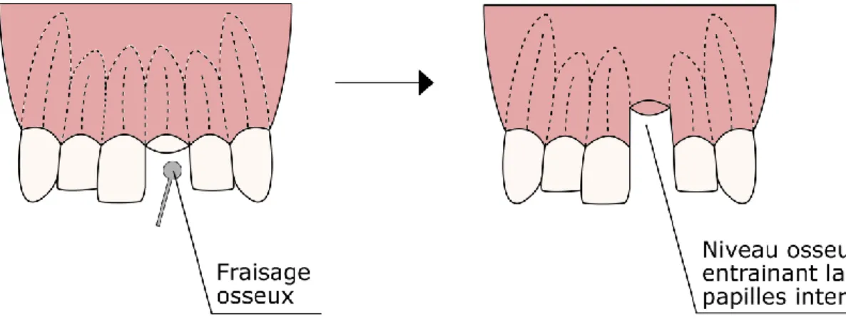 Figure 19. Conséquences du fraisage osseux lors d'une avulsion au niveau antérieur. 