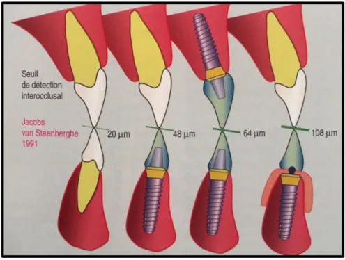 Fig. 1.7. Seuil de détection inter-occlusal en fonction des éléments dentaires et/ou  implantaires en affrontement