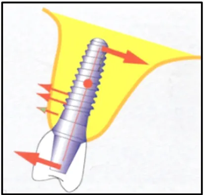 Fig. 1.10. Déplacement du centre de rotation au niveau d’un implant conique. (20) 